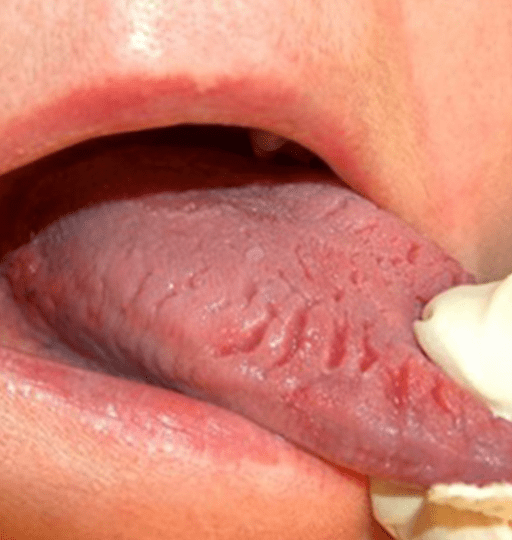 Health Signs Your Tongue May Be Giving You Dailywize 7933